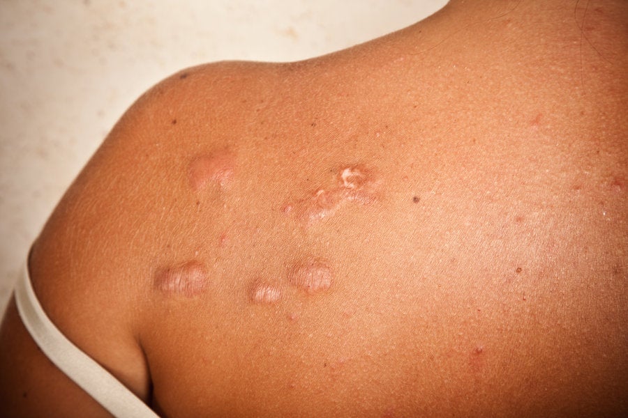 Black Skin Care 101 What Are Keloid Scars And How Do Black Women You Get Rid Of Them Essence 1596