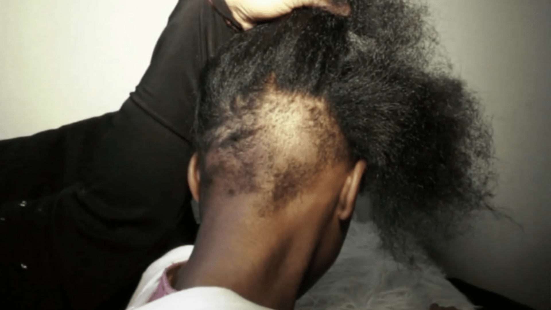 Philadelphia Mom Says Daughter's Hair Was Cut Out By Classmate