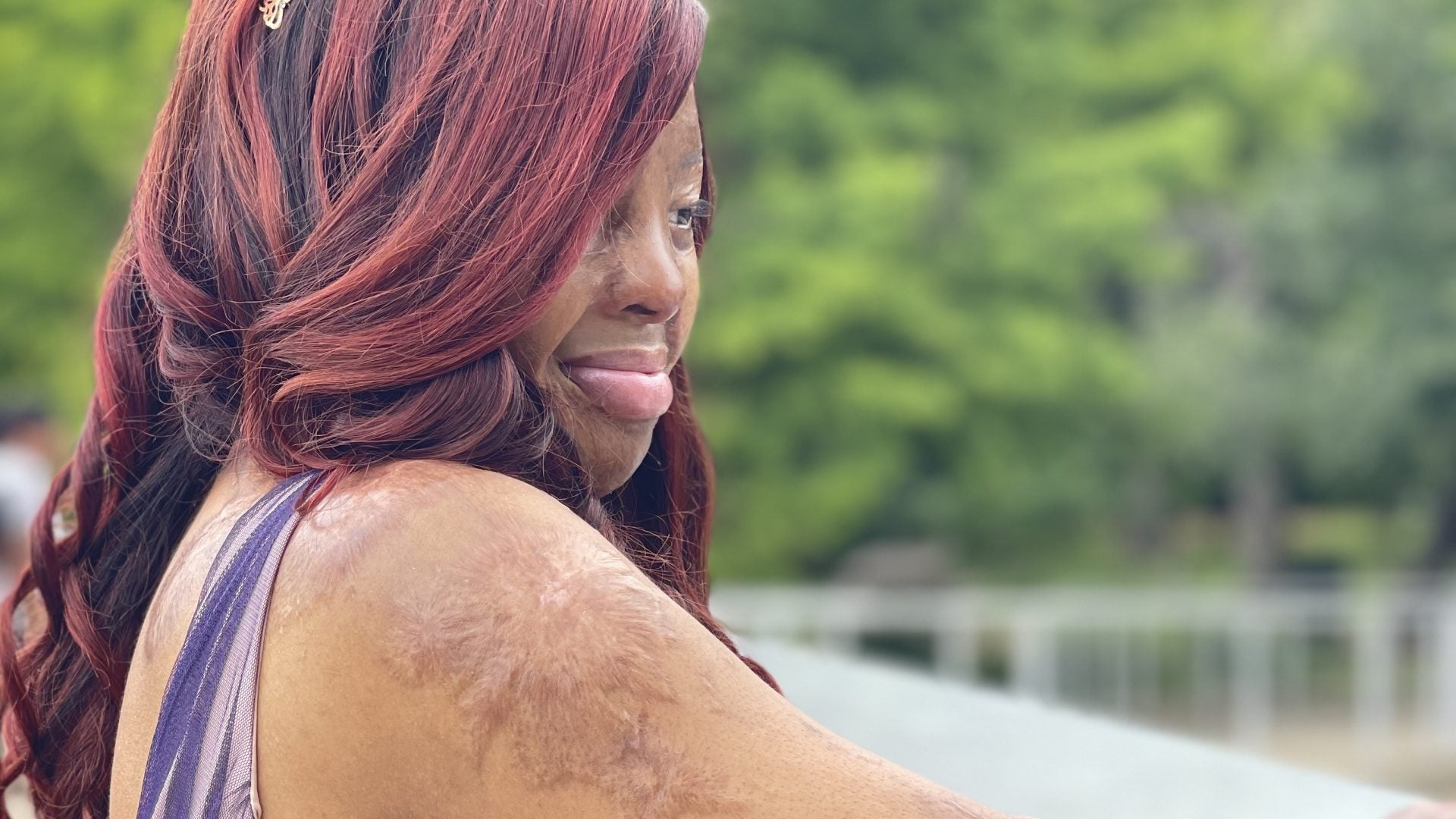 Kechi Okwuchi Is A Burn Survivor Advocate Who Wants Fellow Survivors To Feel Seen