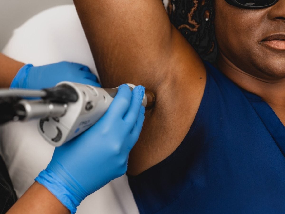 Debunking Myths about Laser Hair Removal for Darker Skin