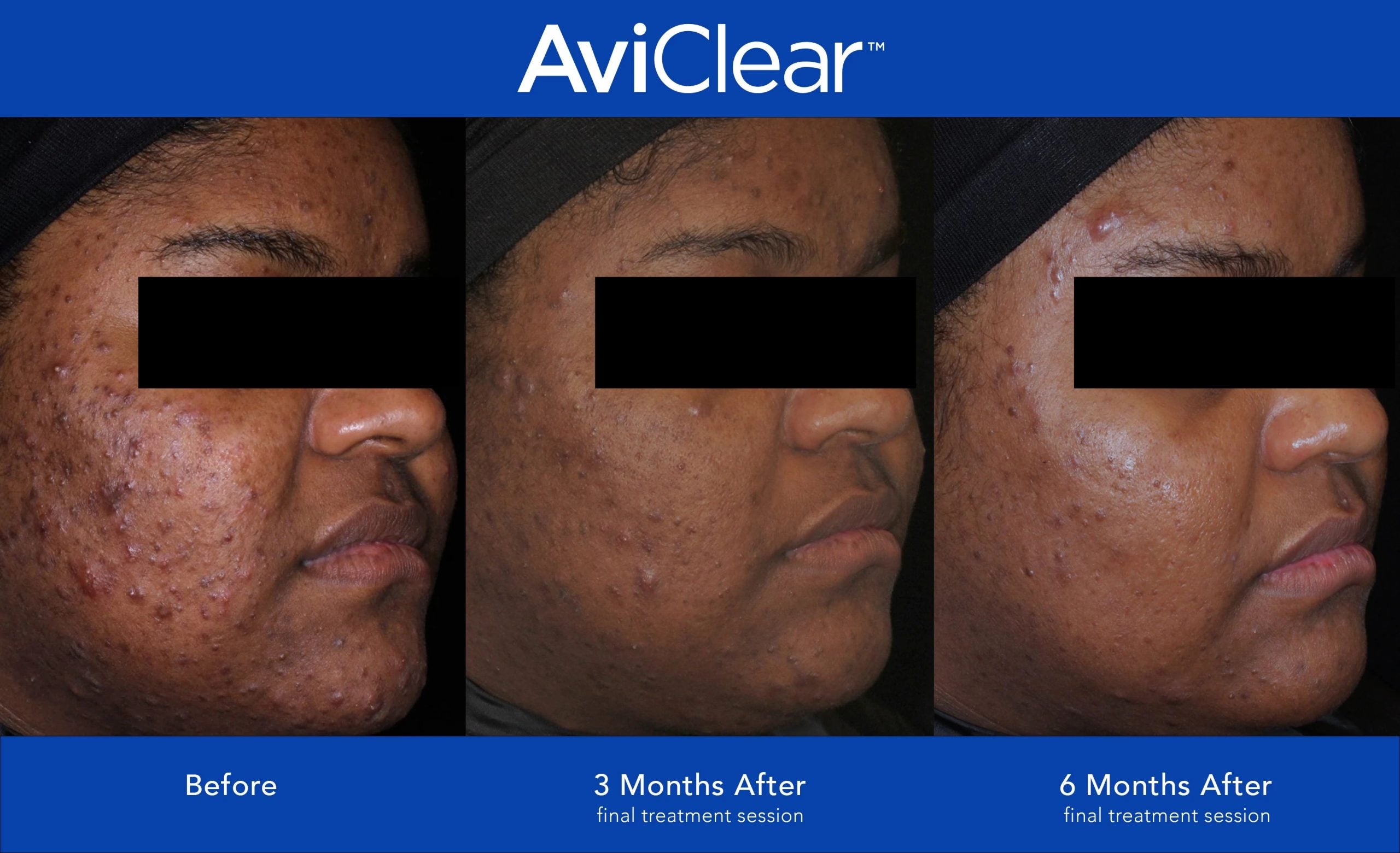 I tried AviClear – A laser treatment for long term acne