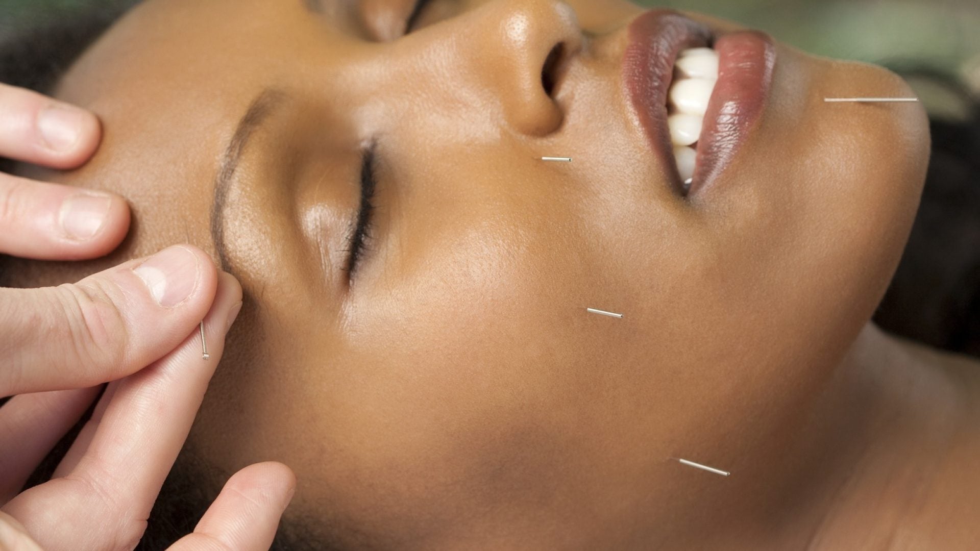 5 Benefits of Acupuncture