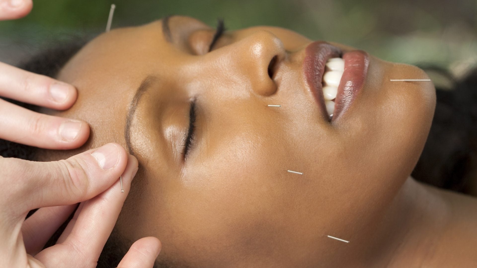 5 Benefits of Acupuncture