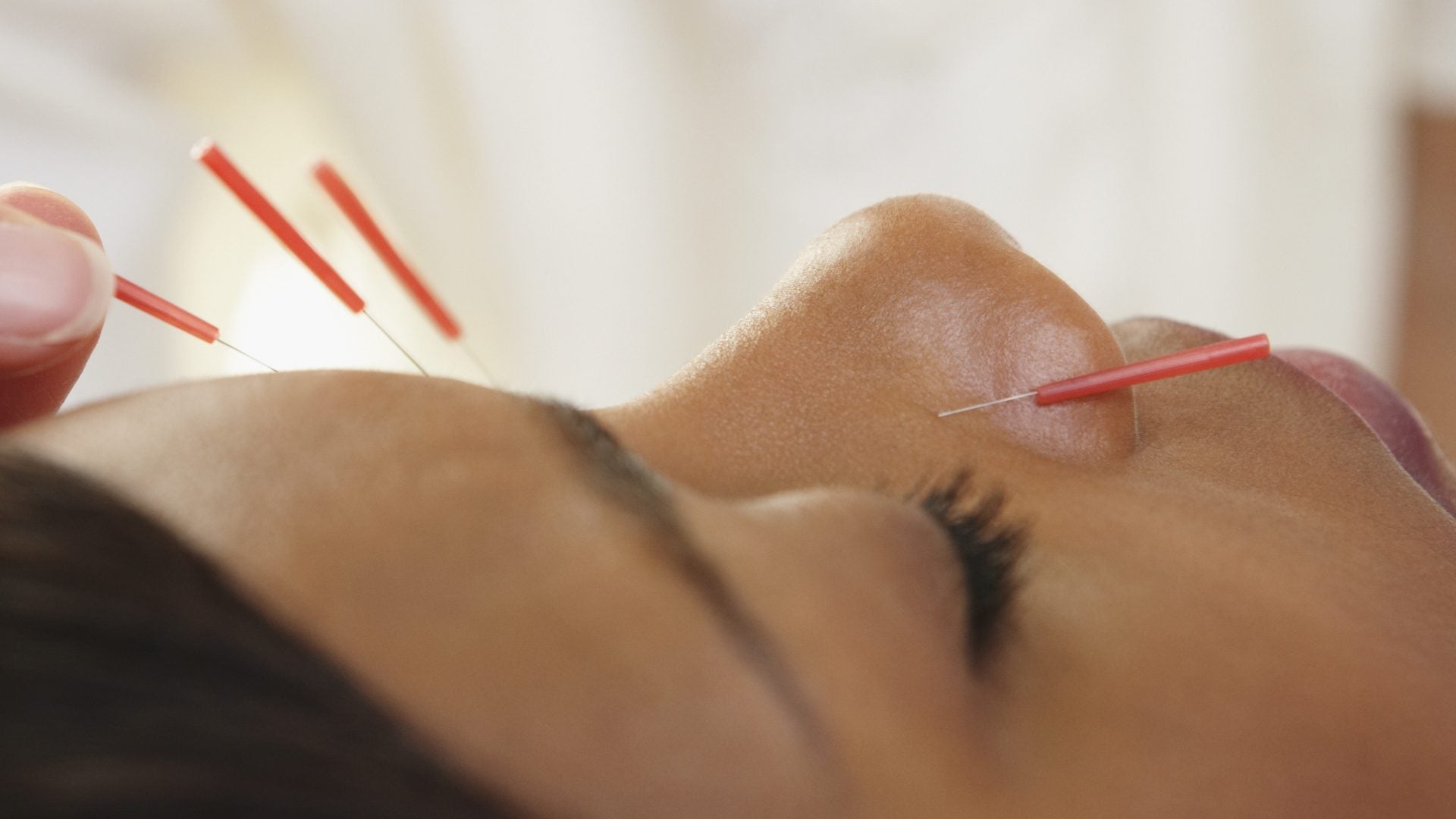 Everything You Need To Know About Facial Acupuncture