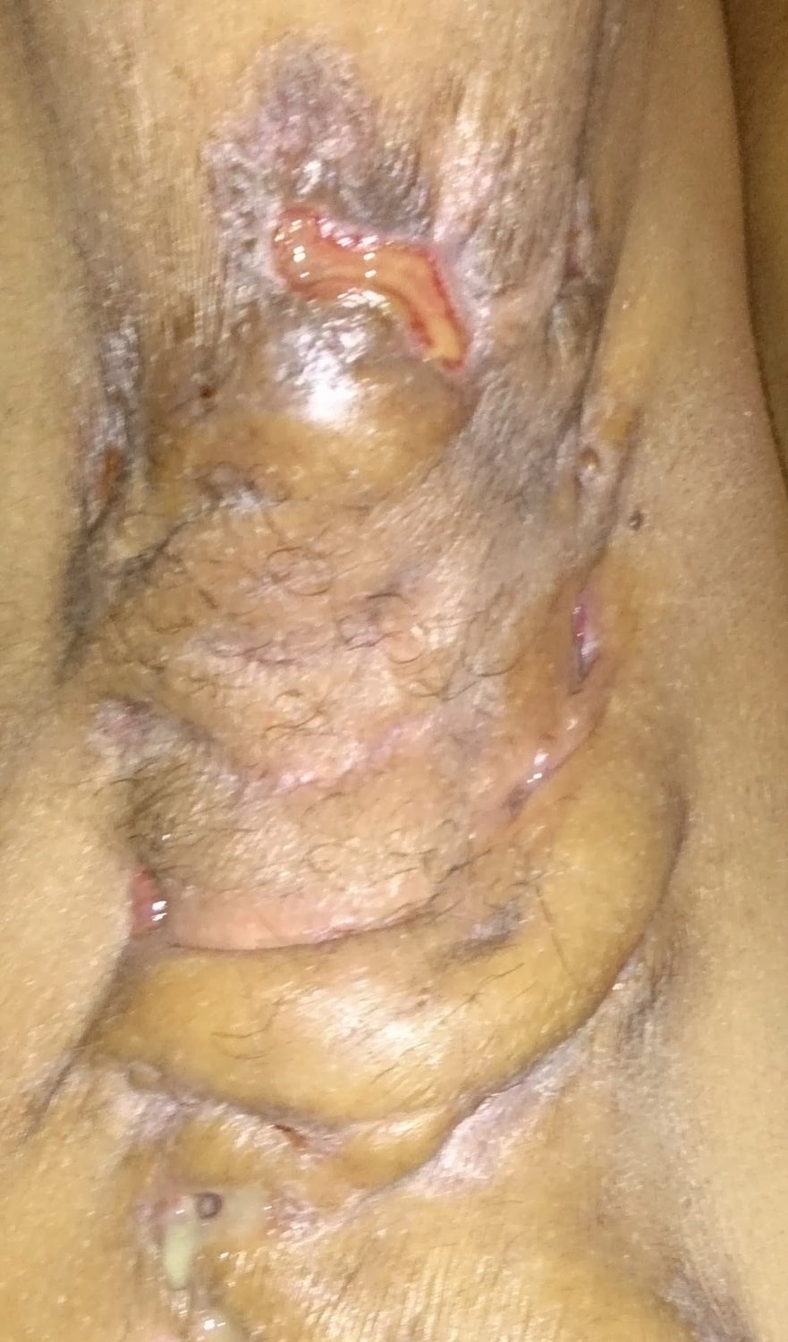 A Woman Diagnosed With Herpes Actually Had This Very Common, Very Painful Skin Condition