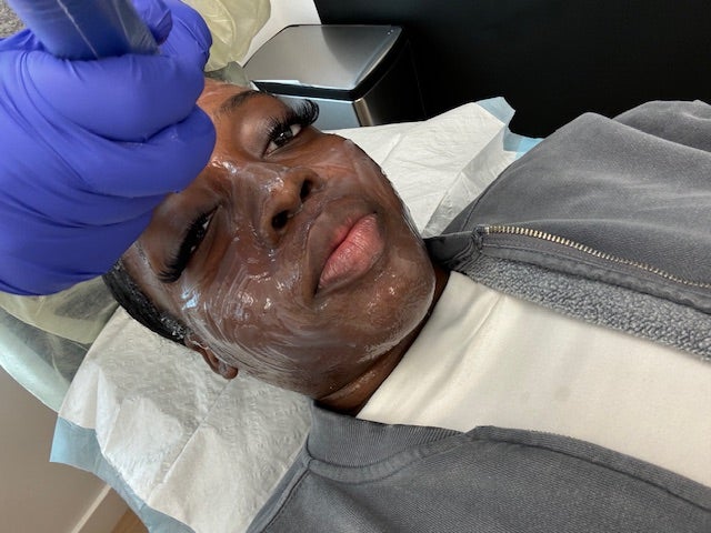 I Tried Professional Microneedling—Here Are My Thoughts