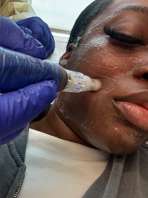 I Tried Professional Microneedling—Here Are My Thoughts