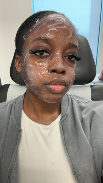 I Tried Professional Microneedling—Here Are My Thoughts