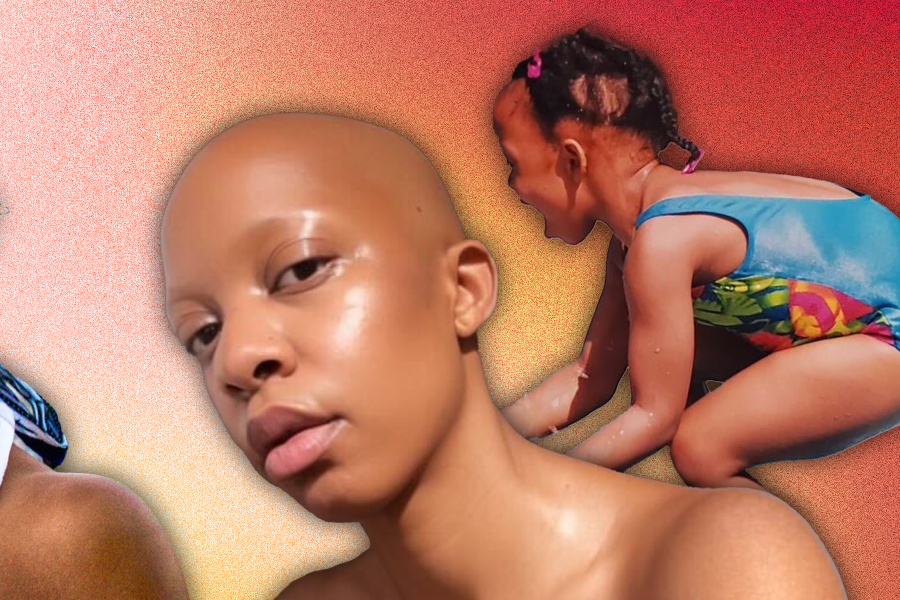 Detangling The Beauty Of Black Women With Alopecia